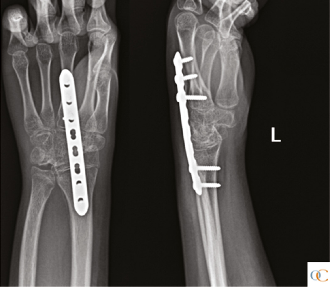 View of Use of Hyperselective Neurectomy in the Management of the Pediatric Spastic Upper