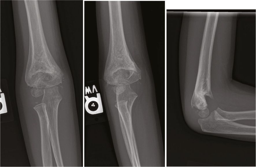 View of Loss of Fixation of a Type IV Supracondylar Humerus Fracture